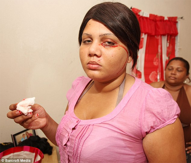 Delfina Cedeno - cô gái 19 tuổi người Dominican là bệnh nhân mới nhất được phát hiện thường xuyên khóc ra máu
