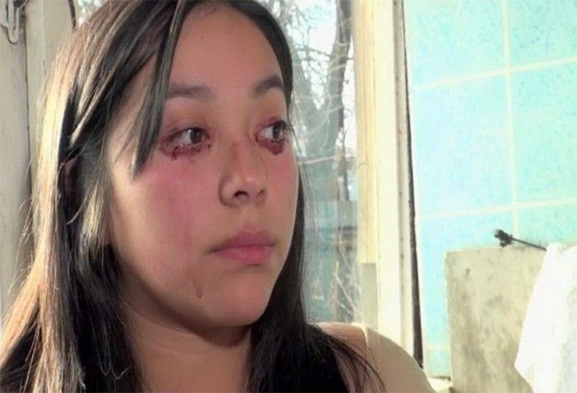 Trước đây Yaritza Oliva - một phụ nữ 20 tuổi người Chi Lê cũng từng mắc chứng bệnh này

