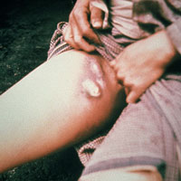 Sức khỏe đời sống - Bùng phát dịch hạch: Hơn 20 người chết