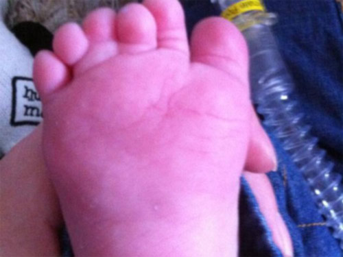Bệnh hiếm gặp: Bé trai có 12 ngón chân, 12 ngón tay - 1