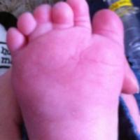 Sức khỏe đời sống - Bệnh hiếm gặp: Bé trai có 12 ngón chân, 12 ngón tay