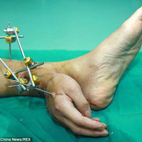 Tin tức trong ngày - TQ: Kỳ lạ người đàn ông "mọc" tay ở mắt cá chân