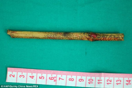 Bị thanh tre 12cm đâm xuyên má mà không biết - 3