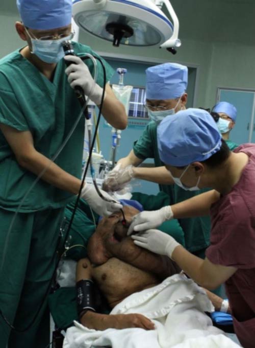 Người đàn ông có khối u nặng 17,5 kg trên mặt - 2