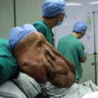 Sức khỏe đời sống - Người đàn ông có khối u nặng 17,5 kg trên mặt