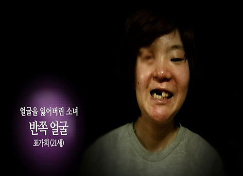 Cô gái mất nửa mặt tìm lại nhan sắc nhờ dao kéo - 2