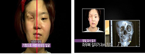 Cô gái mất nửa mặt tìm lại nhan sắc nhờ dao kéo - 3