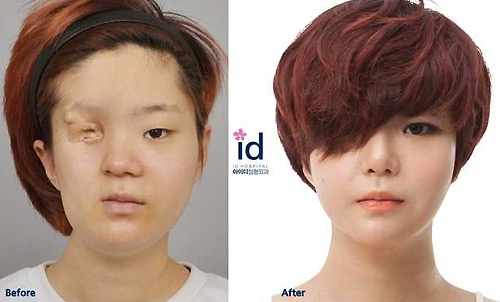 Cô gái mất nửa mặt tìm lại nhan sắc nhờ dao kéo - 6