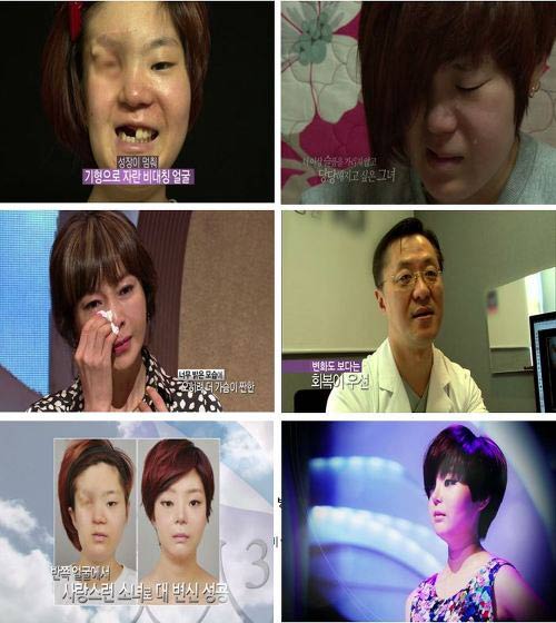 Cô gái mất nửa mặt tìm lại nhan sắc nhờ dao kéo - 4