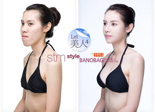 3 thiếu nữ Thái "xinh đẹp hơn tiên" nhờ dao kéo - 4