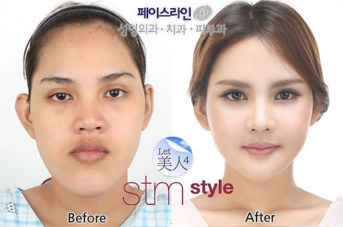 3 thiếu nữ Thái "xinh đẹp hơn tiên" nhờ dao kéo - 2