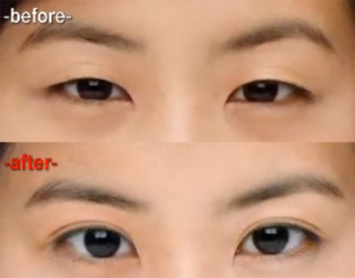 6 kiểu phẫu thuật thẩm mỹ khiến giới trẻ say mê - 3