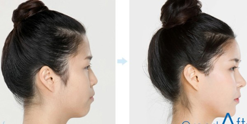 6 kiểu phẫu thuật thẩm mỹ khiến giới trẻ say mê - 4