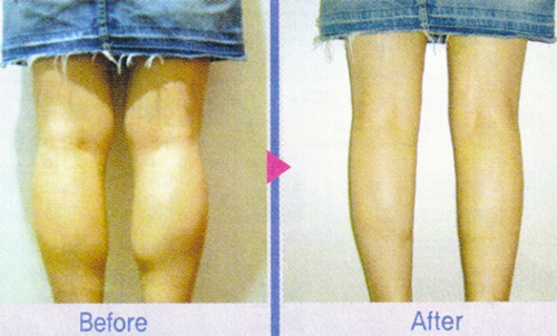 6 kiểu phẫu thuật thẩm mỹ khiến giới trẻ say mê - 6