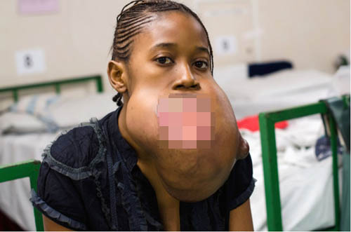 Sốc với khối u khổng lồ ở miệng của thiếu nữ 17 tuổi - 1