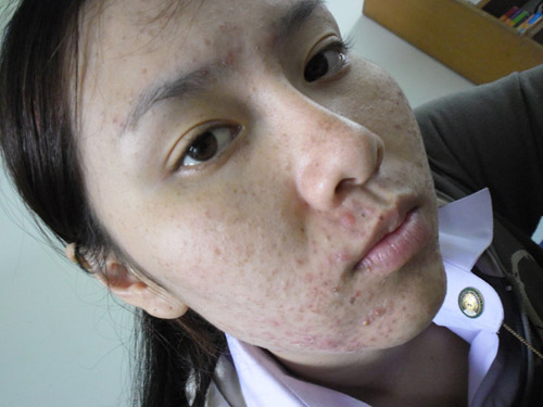 Cô gái Thái tan hoang mặt mày vì bôi kem trắng da rởm - 4