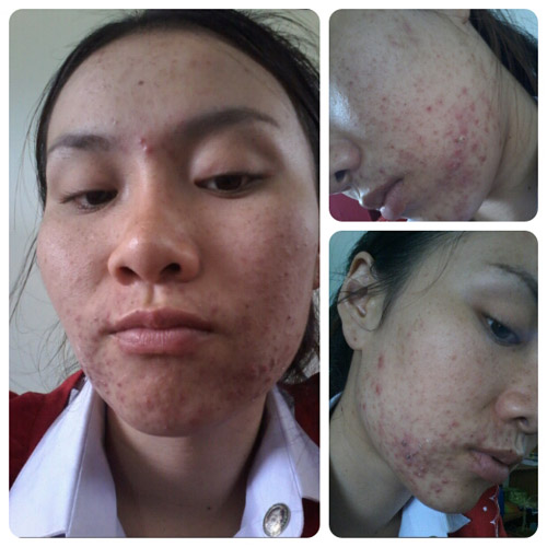 Cô gái Thái tan hoang mặt mày vì bôi kem trắng da rởm - 5