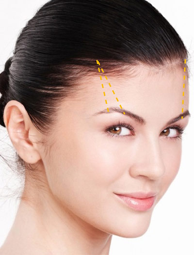 Nâng cung mày, treo mí sụp không phẫu thuật - 1