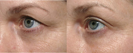 Nâng cung mày, treo mí sụp không phẫu thuật - 2