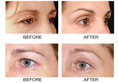 Nâng cung mày, treo mí sụp không phẫu thuật - 3