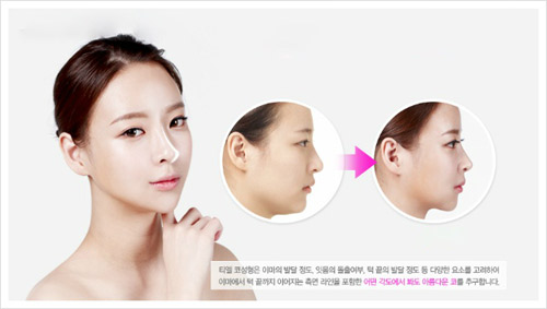Bật mí tuyệt chiêu thẩm mỹ mũi của thiếu nữ Hàn - 3