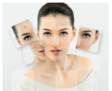 Belas Spa ưu đãi lớn cho dịch vụ xóa sẹo, thâm - 1