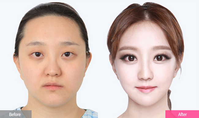 Sau khi phẫu thuật thành công, bà mẹ trẻ Kim Jin có gương mặt trẻ như gái 18. 
