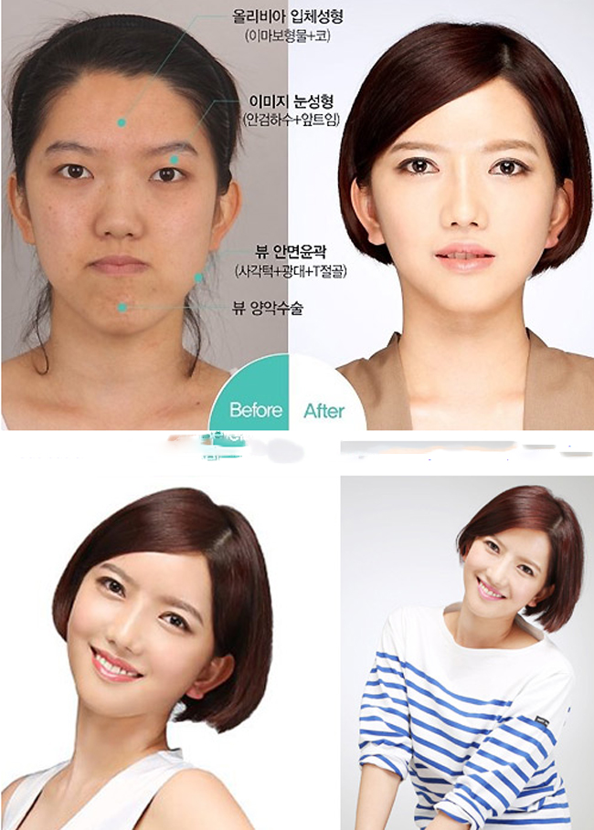 Cô gái&nbsp;Choi Ji Hye từng bị chê bai vì&nbsp;khuôn mặt như&nbsp;gãy đôi với phần hàm dưới biến dạng.
