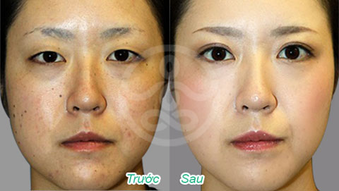 4 cách đơn giản để “thổi bay” vết nám da - 6