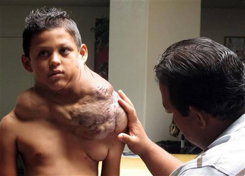 Loại bỏ khối u khổng lồ trên vai cậu bé 11 tuổi - 1