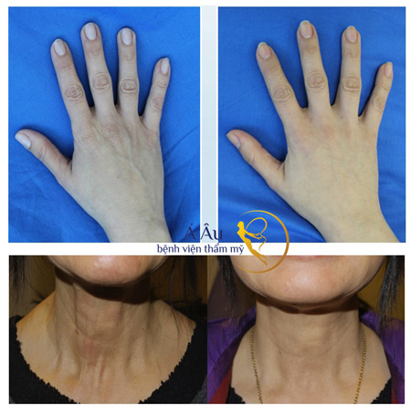 Căng da chỉ vàng nhận vàng miếng "mã đáo thành công" - 3