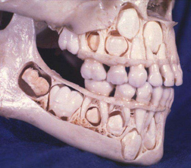 9 – Hộp sọ trẻ em trước khi chúng thay răng


