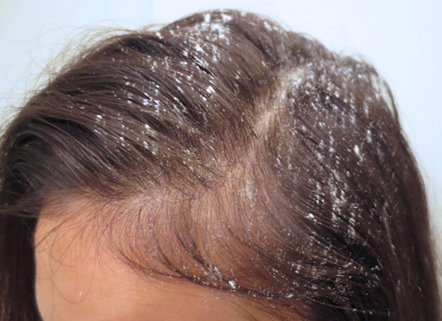 Phấn rôm trẻ em cũng có thể làm đẹp! - 3