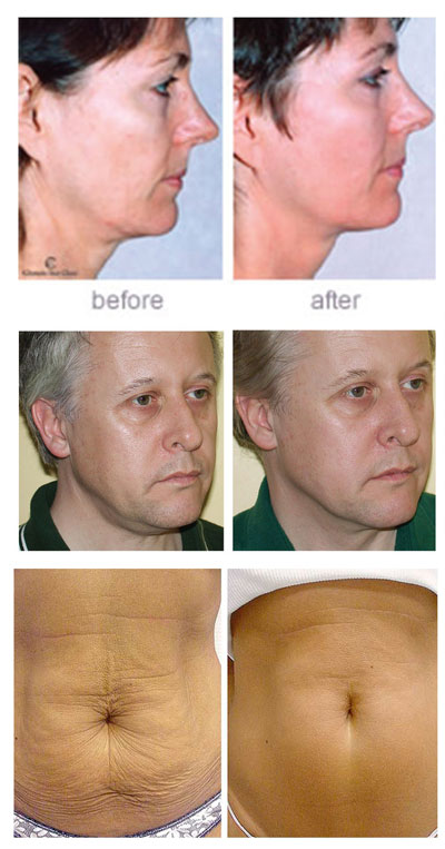 Căng da Thermage 2015 hiệu quả gấp đôi - 2