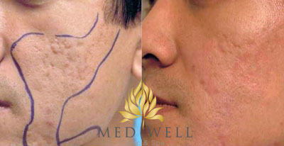 Trị sẹo miễn phí với công nghệ thay da vi điểm - 2