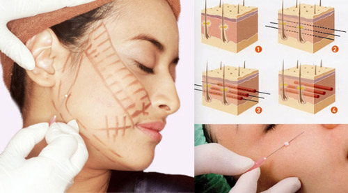 Xóa nọng cằm nhanh chóng với chỉ Ultra V-lift - 2