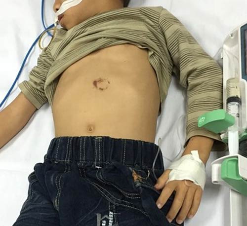 Ngã xe đạp, cháu bé 7 tuổi bị vỡ tụy - 1