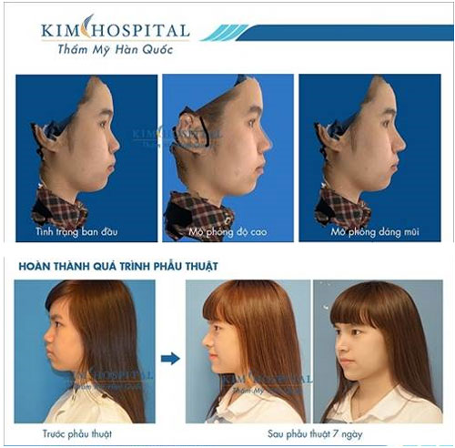 Nâng mũi bị biến chứng phải xử lý như thế nào? - 2