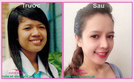 Điều trị hô móm bằng thẩm mỹ chỉnh hàm Hàn Quốc - 1