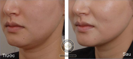 Sự kỳ diệu từ công nghệ trẻ hóa da đỉnh cao Ultherapy - 4