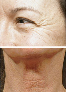 Giải pháp nổi trội trong xóa nhăn, trẻ hóa da - 2