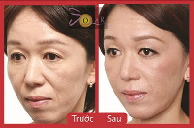 Ưu điểm của công nghệ căng da mặt không phẫu thuật - 3