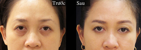 Tại sao nên làm đẹp đôi mắt? - 1