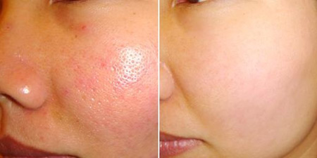 Bí quyết đặc trị lỗ chân lông to - 3