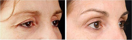 Nâng cung mày: sửa điểm nhỏ, cải thiện lớn cho khuôn mặt - 4