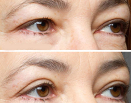 Nâng cung mày: sửa điểm nhỏ, cải thiện lớn cho khuôn mặt - 3