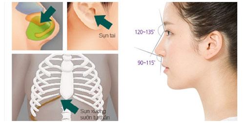 Nên nâng mũi bằng sụn tự thân hay sụn nhân tạo? - 3