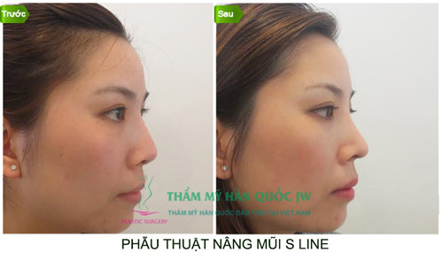 Nên nâng mũi bằng sụn tự thân hay sụn nhân tạo? - 4