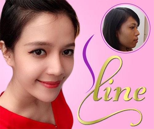 Nên nâng mũi bằng sụn tự thân hay sụn nhân tạo? - 6