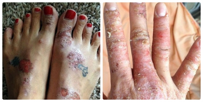 Thiếu nữ bị bong tróc da khắp người sau khi nâng ngực - 3